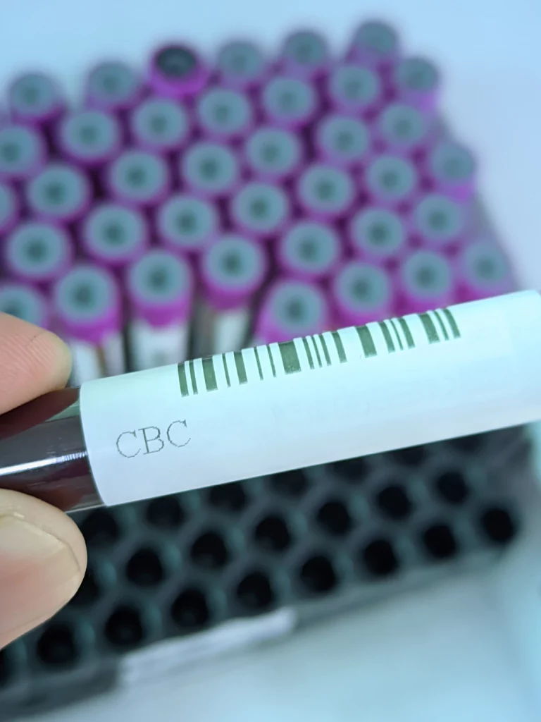 CBC Test কী? বাংলাদেশে খরচ কত ও রিপোর্ট বোঝার সম্পূর্ণ গাইড ২০২৬ 3 CBC test-এর জন্য EDTA (বেগুনি ক্যাপ) blood collection tube — হেমাটোলজি বিশ্লেষণের জন্য ব্যবহৃত laboratory equipment Bangladesh