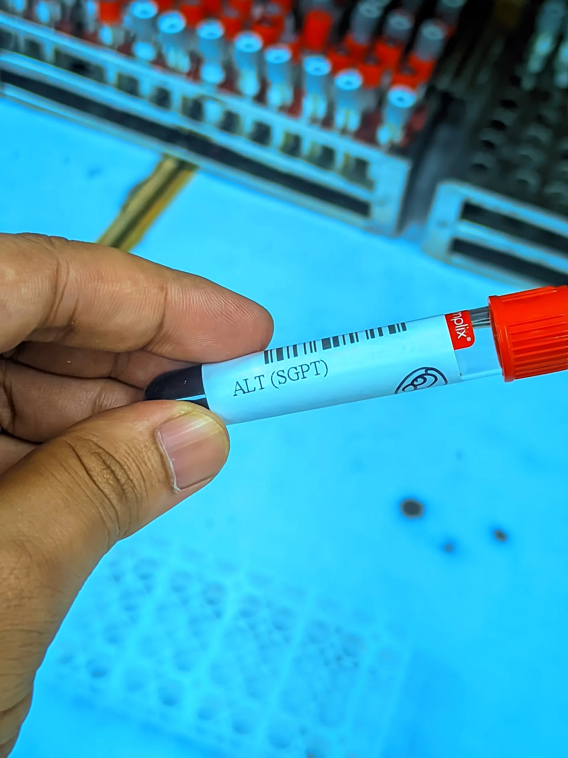 sgpt test কেন করা হয়? sgpt test নরমাল কত? খরচ কত? 2 Sgpt test কেন করা হয়