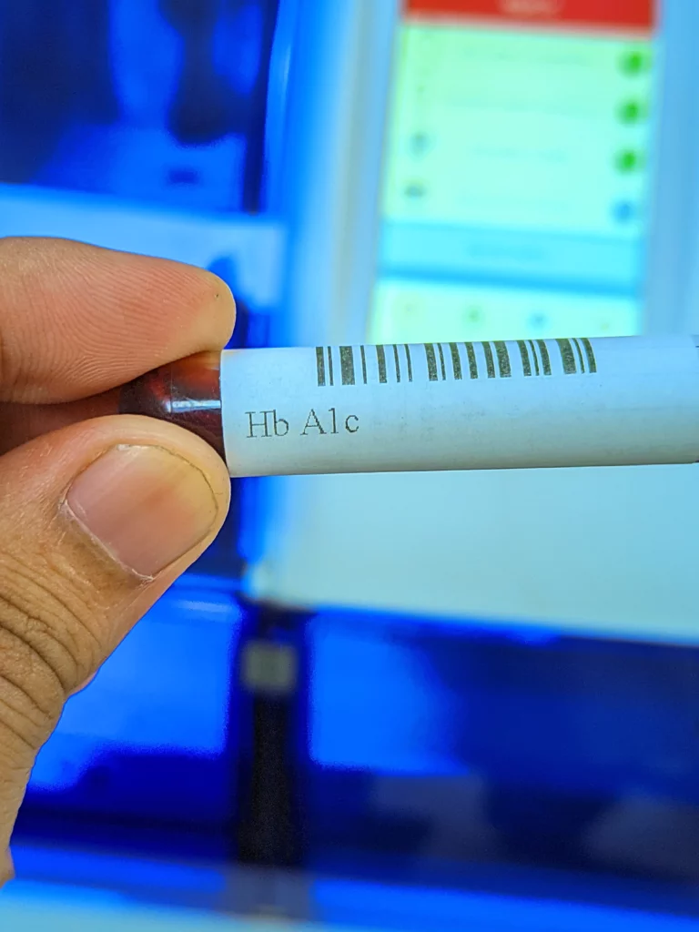 EDTA পার্পেল ক্যাপ টিউব — HbA1c টেস্টের জন্য রক্ত সংগ্রহের সঠিক নমুনা টিউব