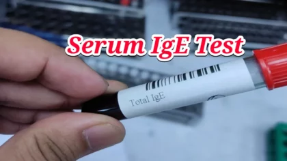 serum ige test price in bangladesh 2026 – total ige blood test in bangla