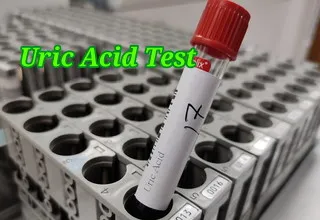 uric acid test