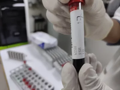 Fsh test নরমাল কত? FSH হরমোন বেড়ে গেলে কি হয়? FSH কমে গেলে কি হয়? Fsh কমানোর উপায় কি? 2 fsh test sample tube