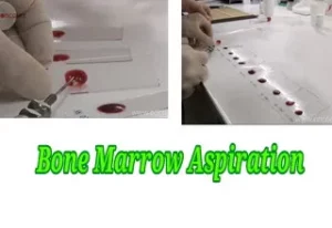 bone marrow test