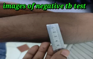 images of negative tb test