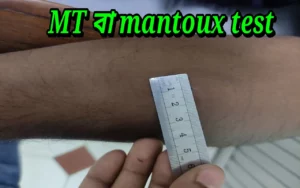 mantoux test কেন করা হয়?