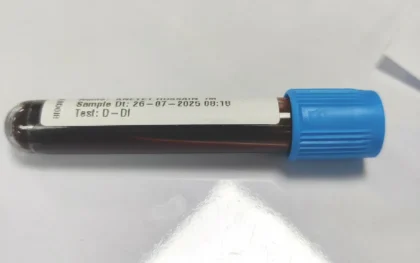 D-Dimer Test: What It Is and Why Doctors Recommend It