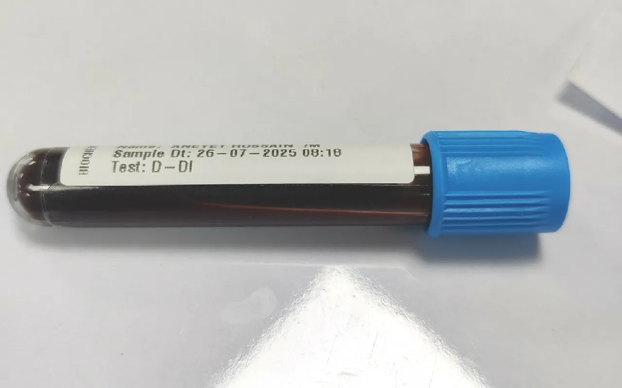 D-Dimer Test: What It Is and Why Doctors Recommend It 1 D-Dimer Test: What It Is and Why Doctors Recommend It